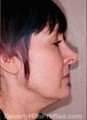Female face, before Neck lift treatment, neck, right side view, patient 1