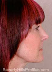 Female face, after Neck lift treatment, neck, right side view, patient 1