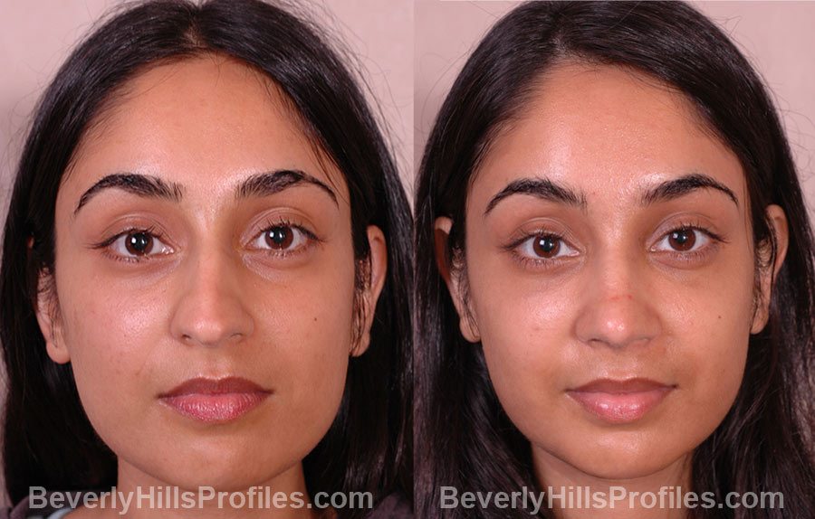 before and after Female Rhinoplasty