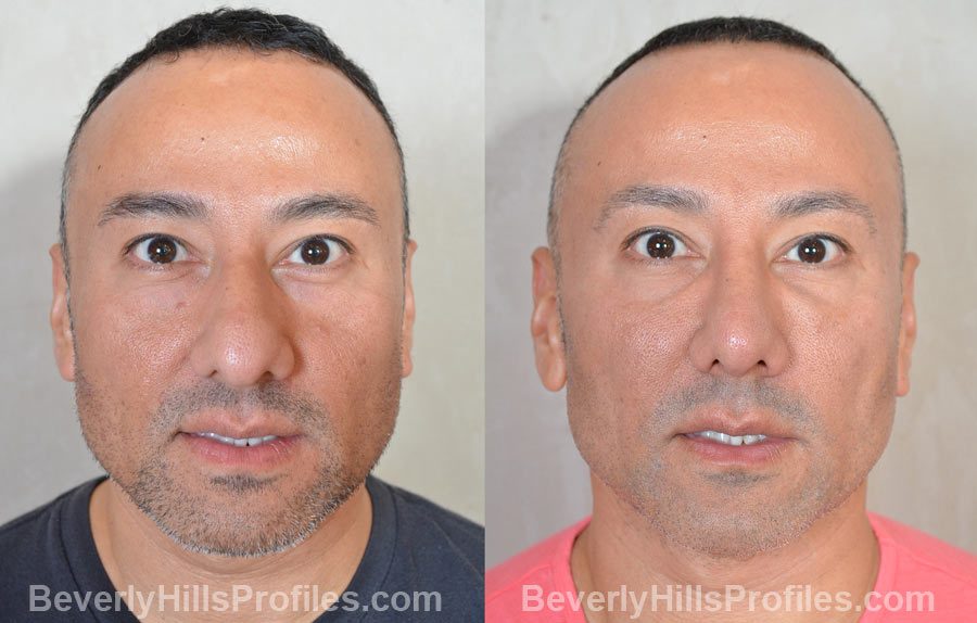 before and after Male Rhinoplasty