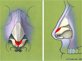 shape of the rhinoplasty surgery - edge cartilages (in red)