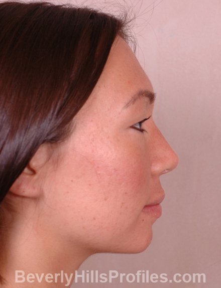 Rhinoplasty After - female, side view