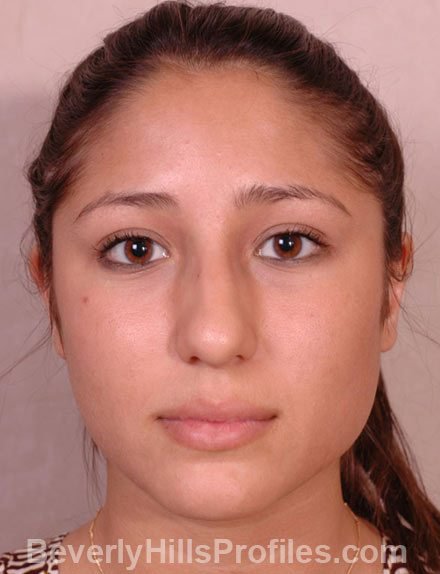 Rhinoplasty Before - female, front view