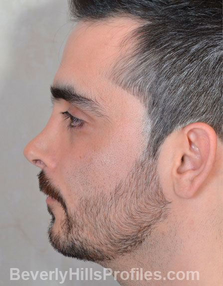 Revision Rhinoplasty Before Photo Gallery - male, side view