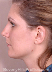 Otoplasty After Photo - female, side view