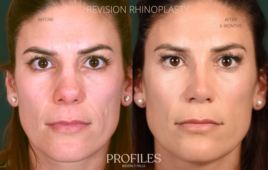 Rhinoplasty before and after photographs