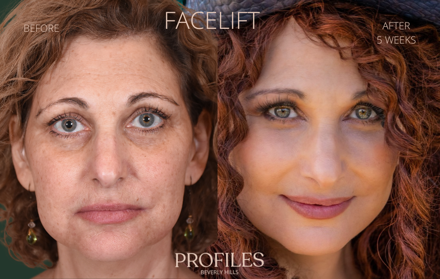 Facial surgery before and after photographs