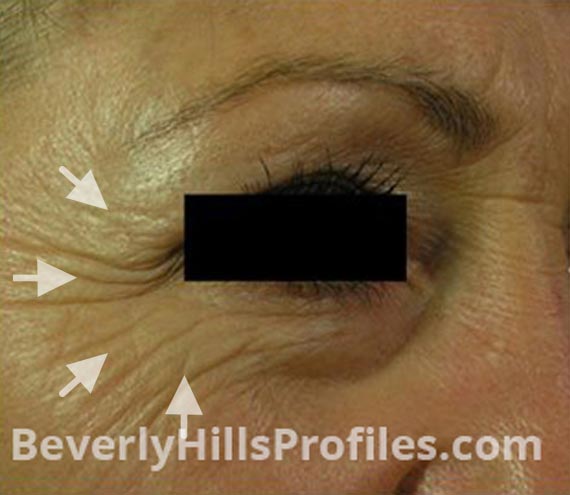 FaceLift, Anti-Wrinkle Injection - Before Treatment Photo - female, right side oblique view, patient 3
