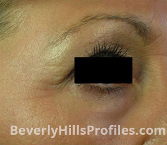 FaceLift, Anti-Wrinkle Injection - After Treatment Photo - female, right side oblique view, patient 3