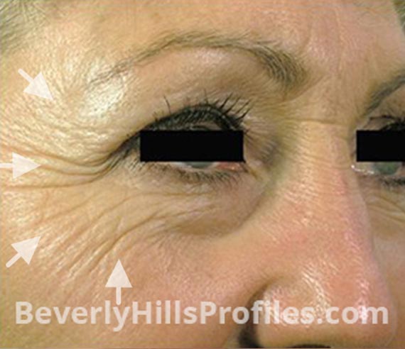 FaceLift, Anti-Wrinkle Injection: Before Treatment Photo - female, right side oblique view, patient 3
