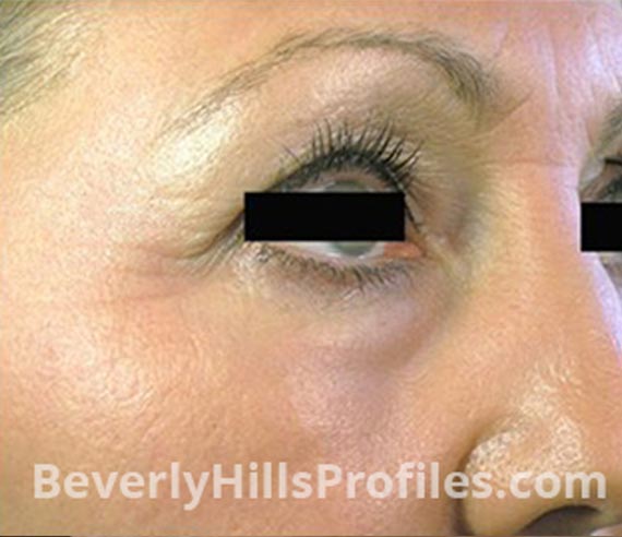 FaceLift, Anti-Wrinkle Injection: After Treatment Photo - female, right side oblique view, patient 3