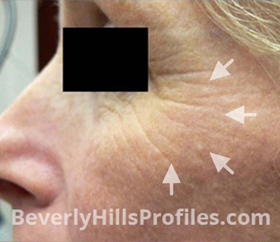 FaceLift, Anti-Wrinkle Injection - Before Treatment Photo - female, left side oblique view, patient 4