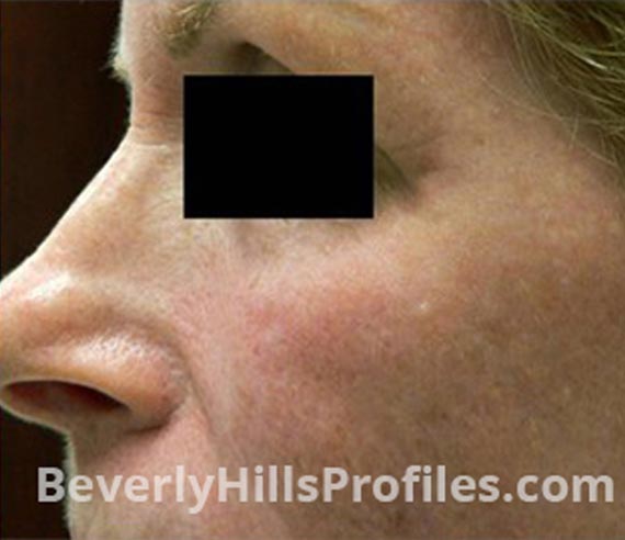 FaceLift, Anti-Wrinkle Injection - After Treatment Photo - female, left  side oblique view, patient 4