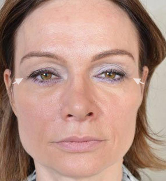 Blepharoplasty Procedure: Before Treatment Photo - female, front view, patient 10