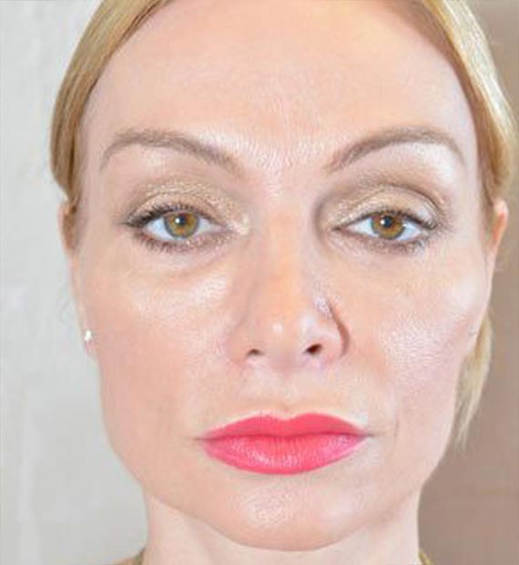 FaceLift - After Treatment Photo - female, front view, patient 5