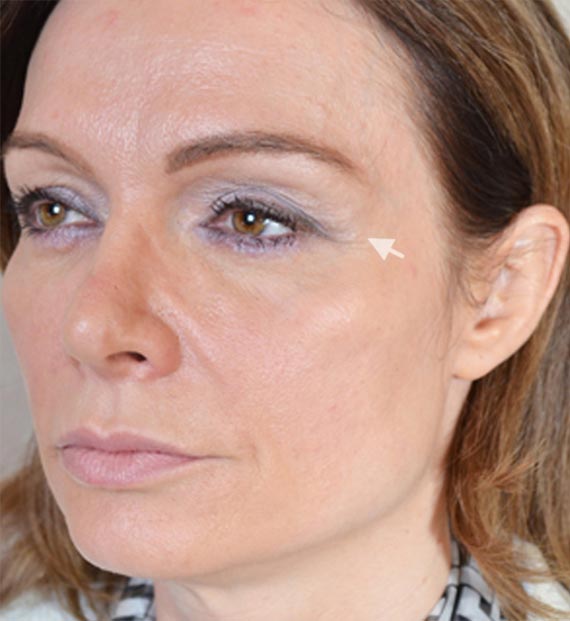 Blepharoplasty Procedure: Before Treatment Photo - female, oblique view, patient 10