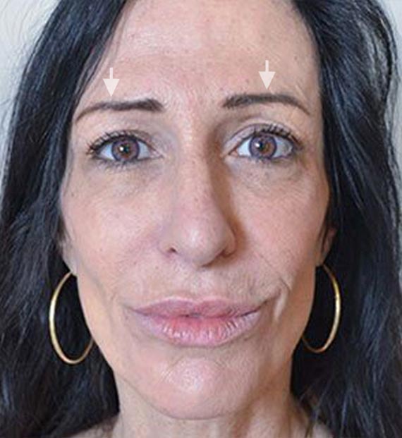 Brow lift - Before Treatment Photo - female, front view, patient 1