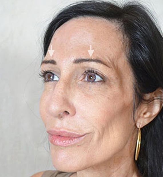 Brow lift - Before Treatment Photo - female, oblique view, patient 1