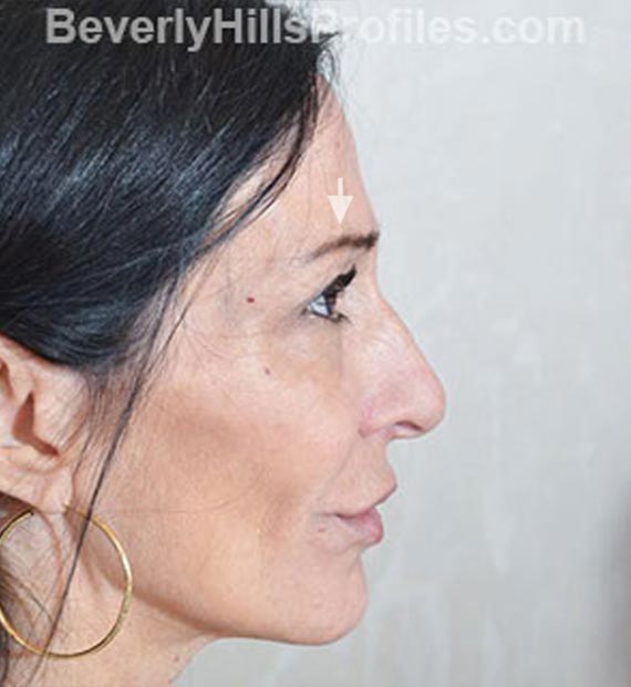 Brow lift - Before Treatment Photo - female, right side view, patient 1