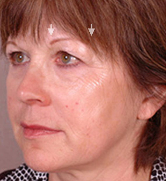 Brow lift - Before Treatment Photo - female, oblique view, patient 2