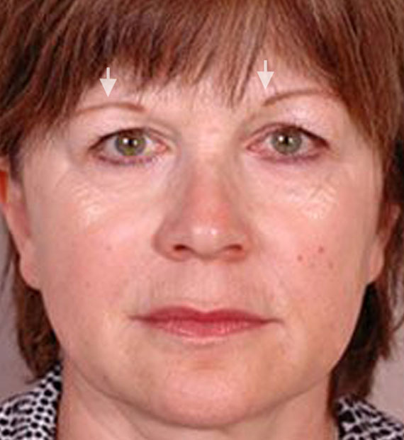Brow lift - Before Treatment Photo - female, front view, patient 2