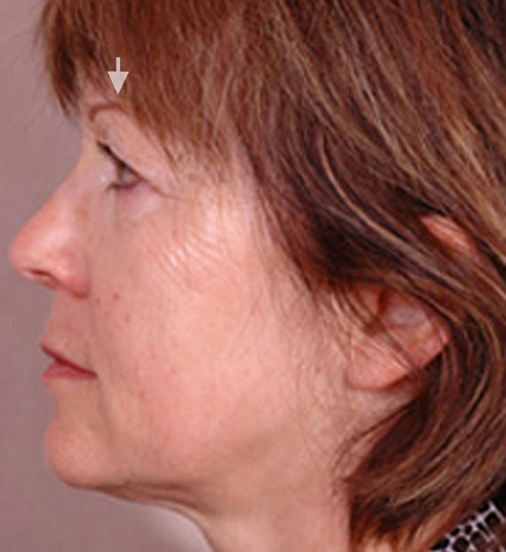 Brow lift - Before Treatment Photo - female, left side view, patient 2