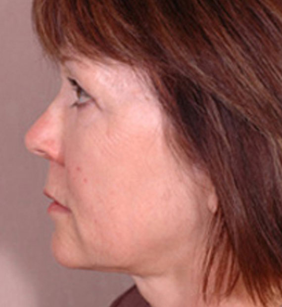 Brow lift - After Treatment Photo - female, left side view, patient 2