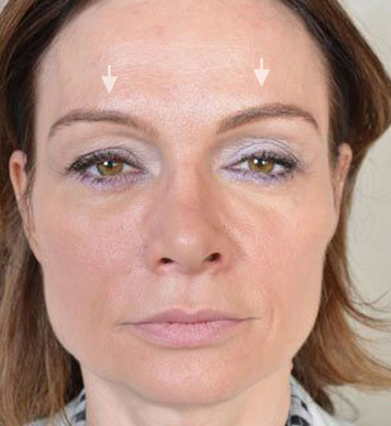 Brow lift - Before Treatment Photo - female, front view, patient 3