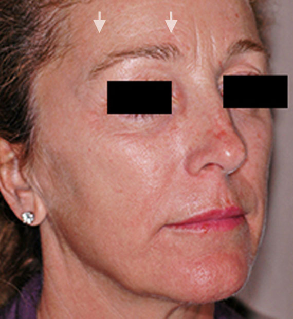 Brow lift - Before Treatment Photo - female, oblique view, patient 4
