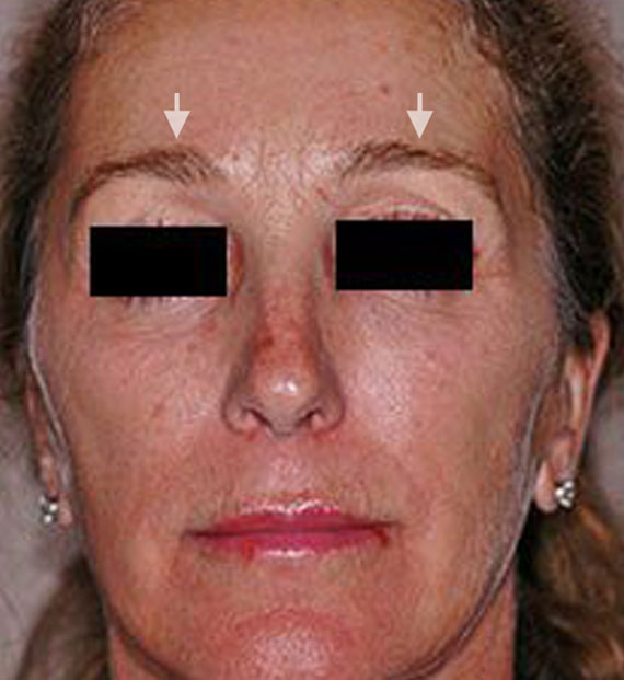 Brow lift - Before Treatment Photo - female, front view, patient 4