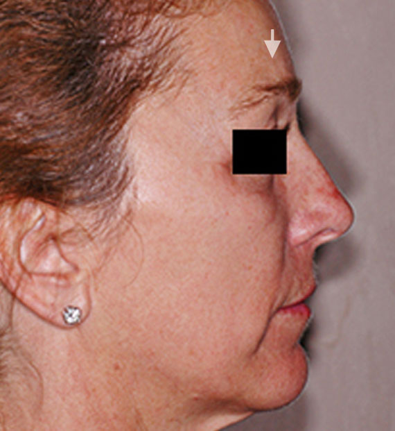 Brow lift - Before Treatment Photo - female, right side view, patient 4