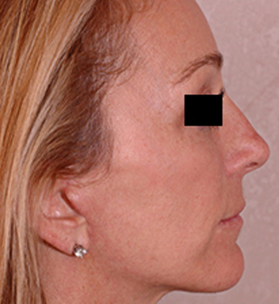 Brow lift - After Treatment Photo - female, right side view, patient 4