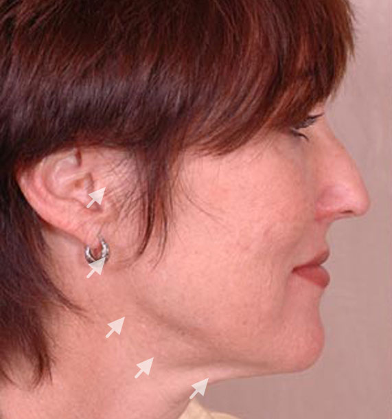 Mini Face Lift Procedure: Before Treatment Photo - female, right side view, patient 14