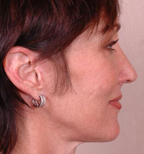 Mini Face Lift Procedure: After Treatment Photo - female, right side view, patient 14