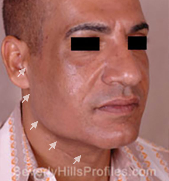 Mini Face Lift Procedure: Before Treatment Photo - male, oblique view, patient 15