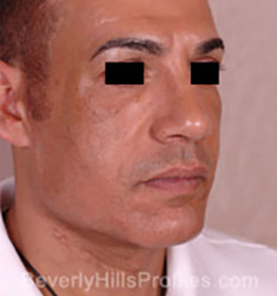 Mini Face Lift Procedure: After Treatment Photo - male, oblique view, patient 15