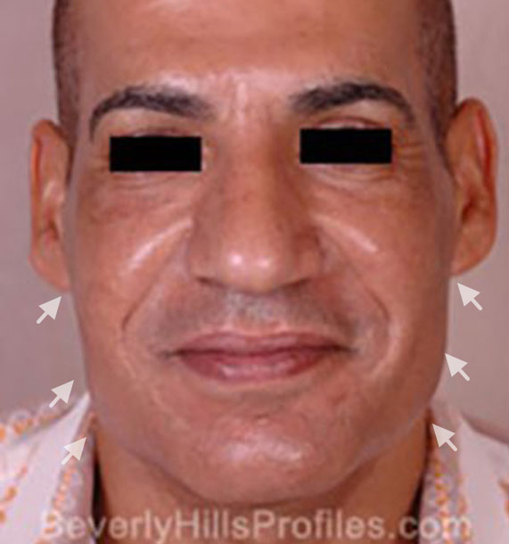 Mini Face Lift Procedure: Before Treatment Photo - male, front view, patient 15