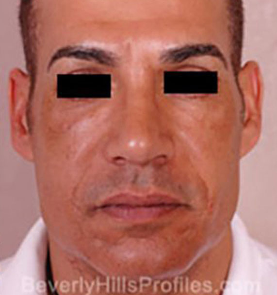 Mini Face Lift Procedure: After Treatment Photo - male, front view, patient 15