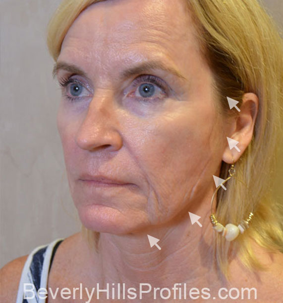 Mini Face Lift Procedure: Before Treatment Photo - female, oblique view, patient 16