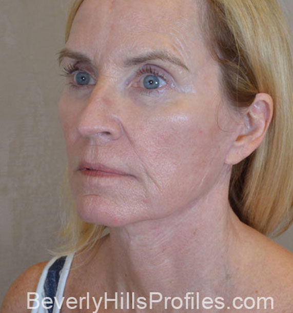 Mini Face Lift Procedure: After Treatment Photo - female, oblique view, patient 16