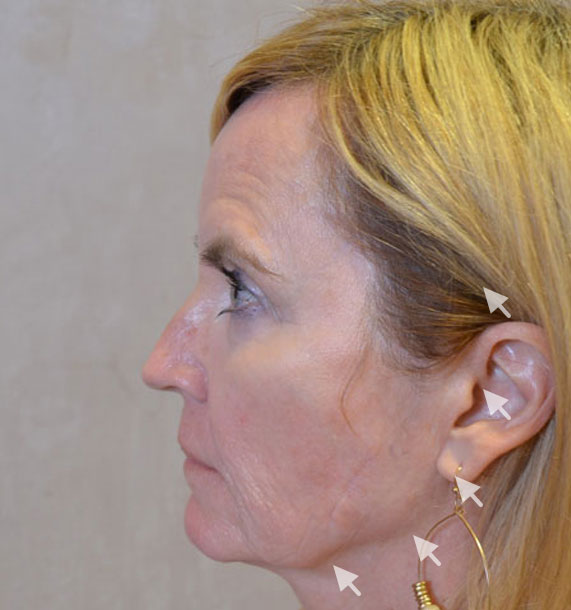 Mini Face Lift Procedure: Before Treatment Photo - female, left side view, patient 16