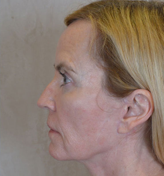 Mini Face Lift Procedure: After Treatment Photo - female, left side view, patient 16