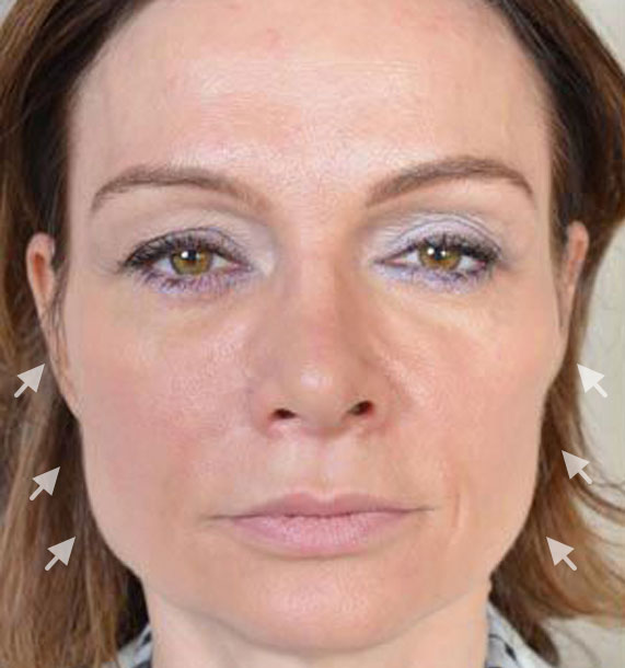 Mini Face Lift Procedure: Before Treatment Photo - female, front view, patient 12