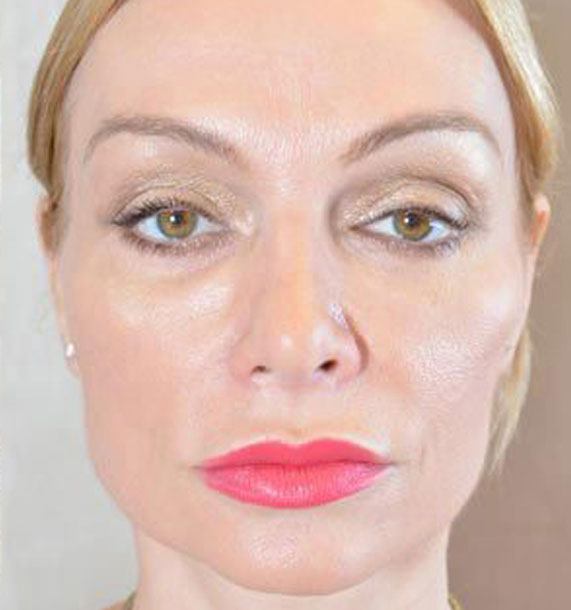 Mini Face Lift Procedure: After Treatment Photo - female, front view, patient 12