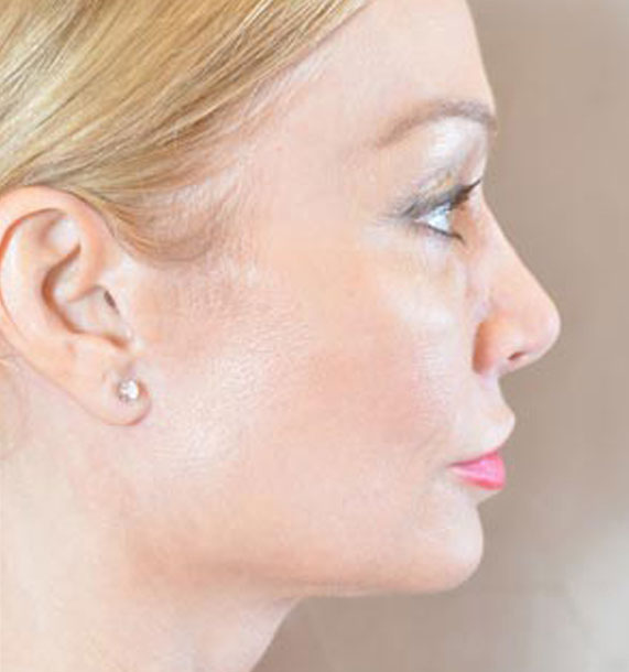 Mini Face Lift Procedure: After Treatment Photo - female, right side view, patient 12