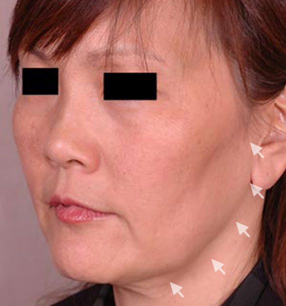 Mini Face Lift Procedure: Before Treatment Photo - female, oblique view, patient 13