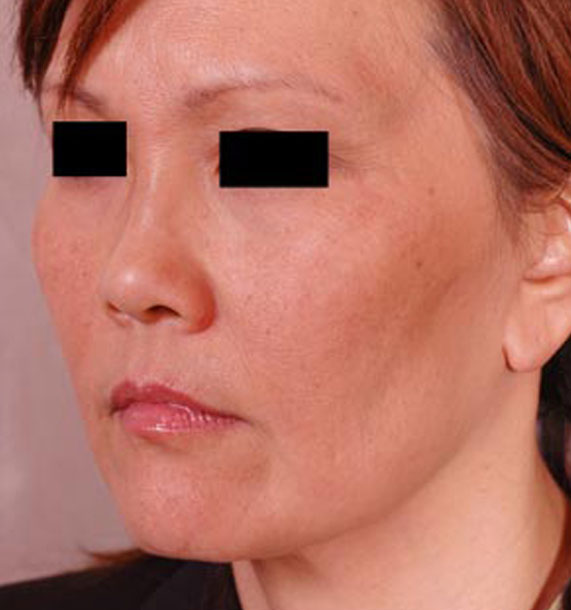 Mini Face Lift Procedure: After Treatment Photo - female, oblique view, patient 13