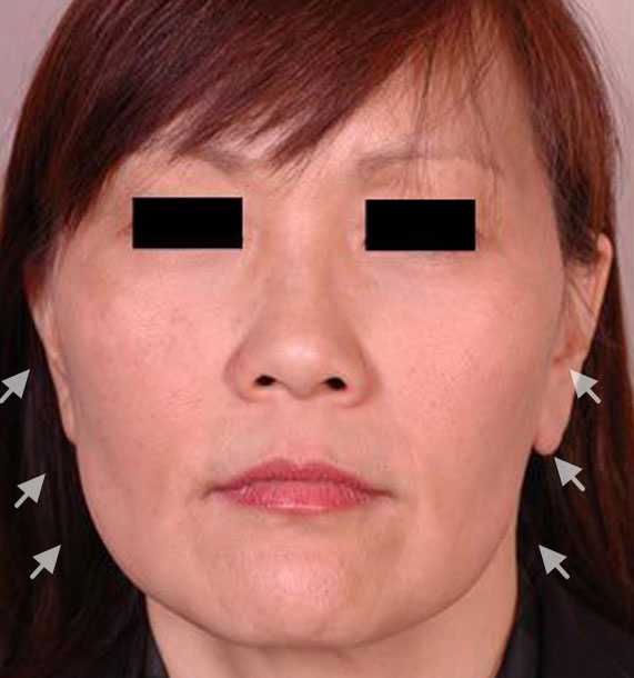 Mini Face Lift Procedure: Before Treatment Photo - female, front view, patient 13