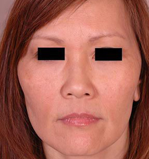 Mini Face Lift Procedure: After Treatment Photo - female, front view, patient 13