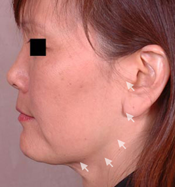 Mini Face Lift Procedure: Before Treatment Photo - female, left side view, patient 13